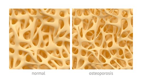 Osteoporóza